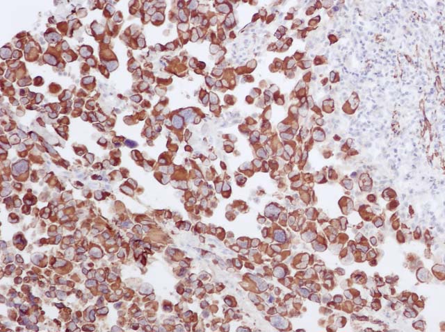 60-0077 61-0077 Ms anti-Desmin clone GM006 stained Rbahdomyosarcoma 