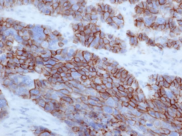 60-0062 61-0062 Ms x CD56 (NCAM) stained Gastric Neuroendocrine tumor 