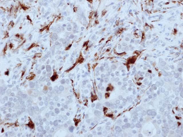 60-0094 61-0094 Ms x CD68 Stained Gastric Adenocarcinoma 