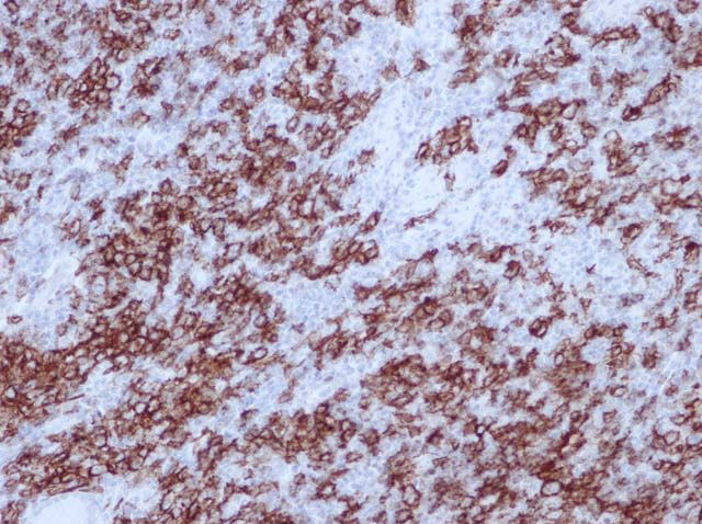 60-0164 Rb x CD19 stained Diffuse Large B Cell Lymphoma 