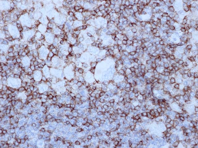 60-0137 61-0137 Ms x CD5 stained Hodgkin's lymphoma 