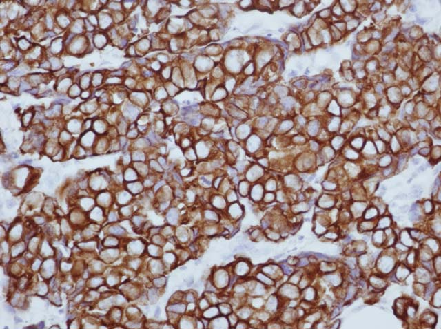 60-0019 61-0019 Cytokeratin 7 Breast Ductal Cancer 