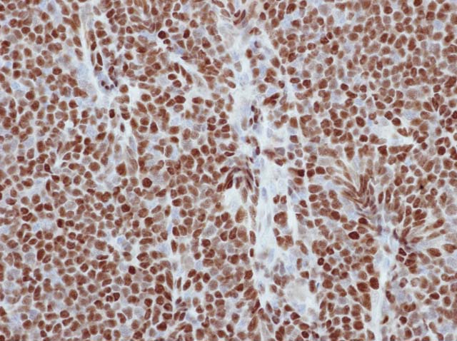 60-0090 61-0090 Rb x Cyclin D1 stained Mantle Cell Lymphoma 