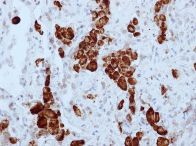 60-0094 61-0094 Ms x CD68 stained lung adenoca 