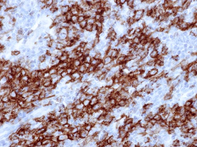 60-0164 Rb x CD19 stained Diffuse Large B Cell Lymphoma 