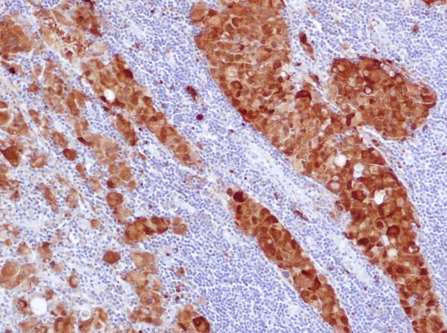 60-0061 61-0061 Rb x S100 stained Melanoma 