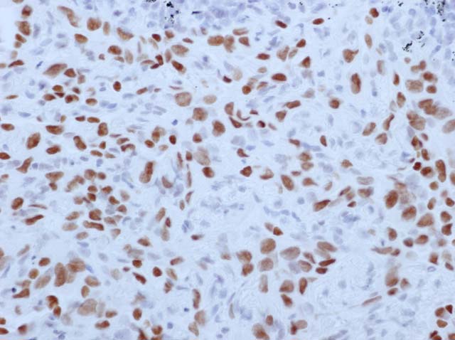 60-0152 61-0152 Ms x TTF1 SPT24 stained Lung adenoca 