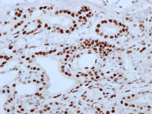 60-0087 61-0087 Ms x AR stained prostate ca 