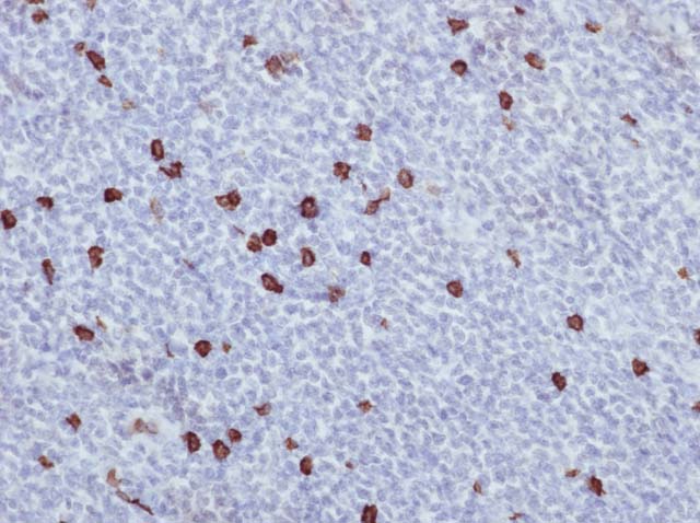 60-0124 61-0124 Ms x CD8 Stained Mantle Cell Lymphoma 