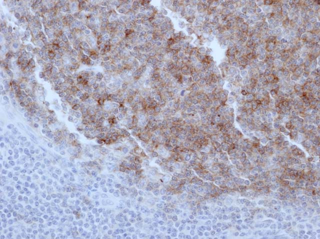 60-0008 61-0008 Ms x CD10 stained follicular B cell NHL 