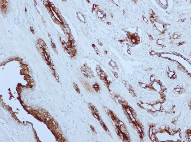 60-0058 61-0058 Rb x PSA stained prostate cancer 