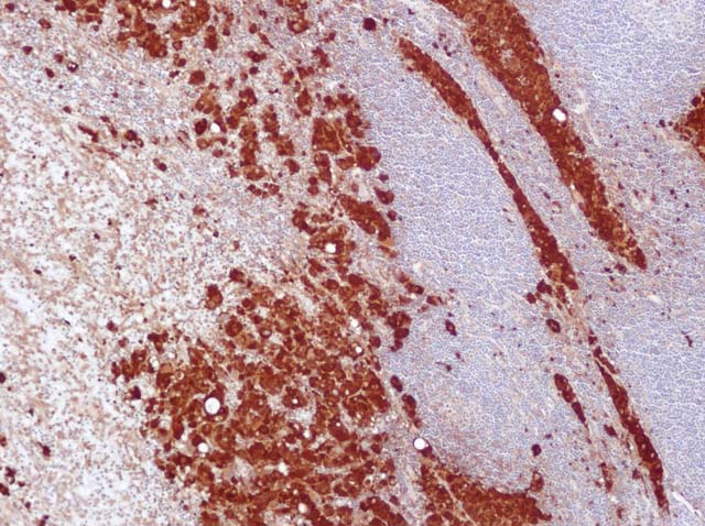 60-0061 61-0061 Rb x S100 Stained melanoma
