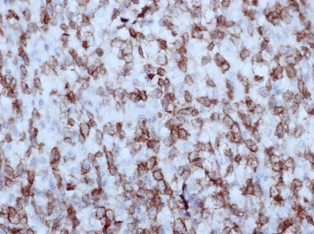 60-0124 61-0124 Ms x CD8 stained T cell lymphoma 