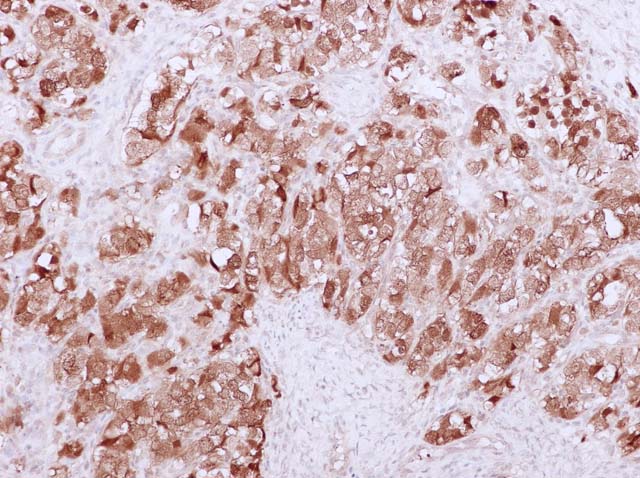60-0006 61-0006 Rb x Calretinin Granulosa Cell Tumor of Ovary x 20 slide7 05112010