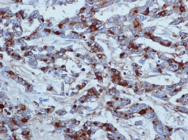 60-0014 61-0014 Ms x CEA stained colon cancer 