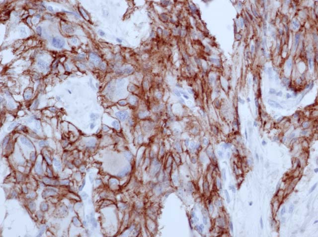 60-0062 61-0062 Ms x CD56 (NCAM) stained Adrenal Paraganglioma 