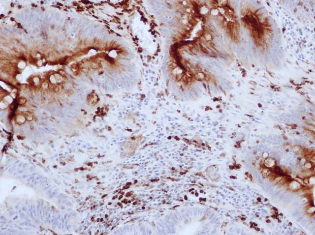 60-0118 61-0118 Rb x Lysozyme stained colon adenoca 