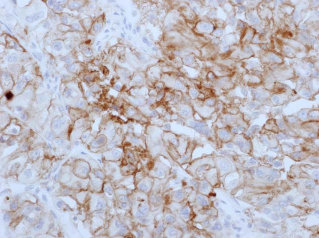 60-0008 61-0008 Ms x CD10 stained renal cell carcinoma 