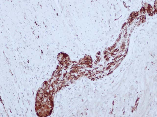 60-0131 61-0131 Ms x NSE stained colon cancer 