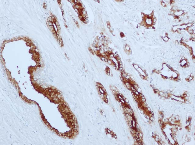60-0057 61-0057 Ms x PSA Clone 140 stained prostate cancer 